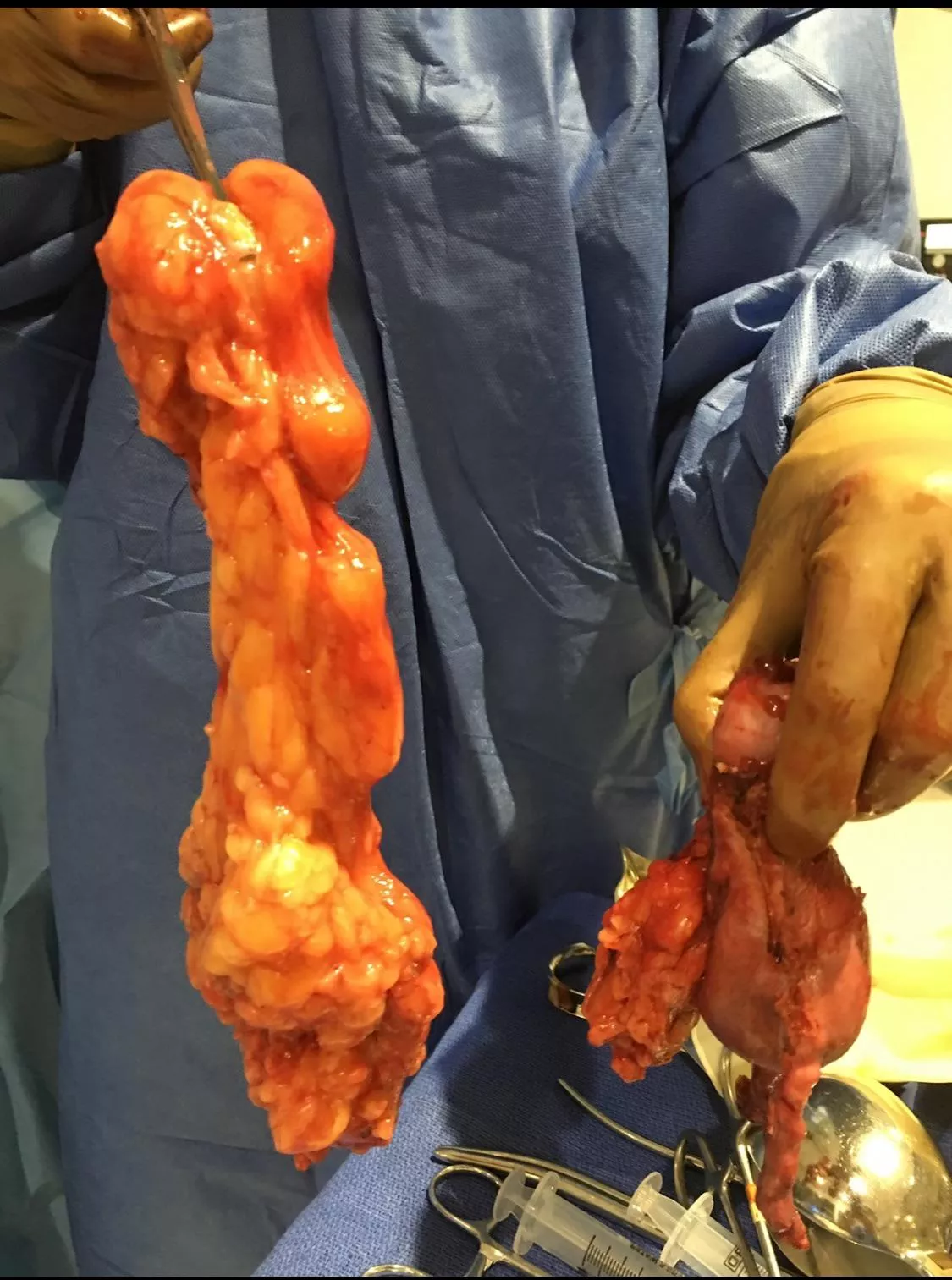 My body grows random abdominal tumors 