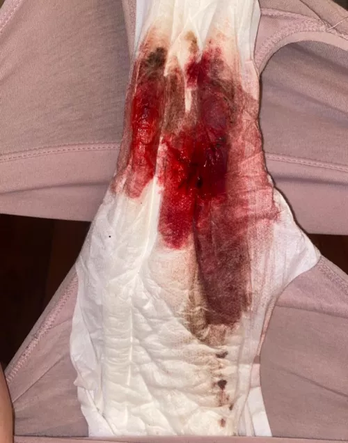 today i had lots of bright red 🩸