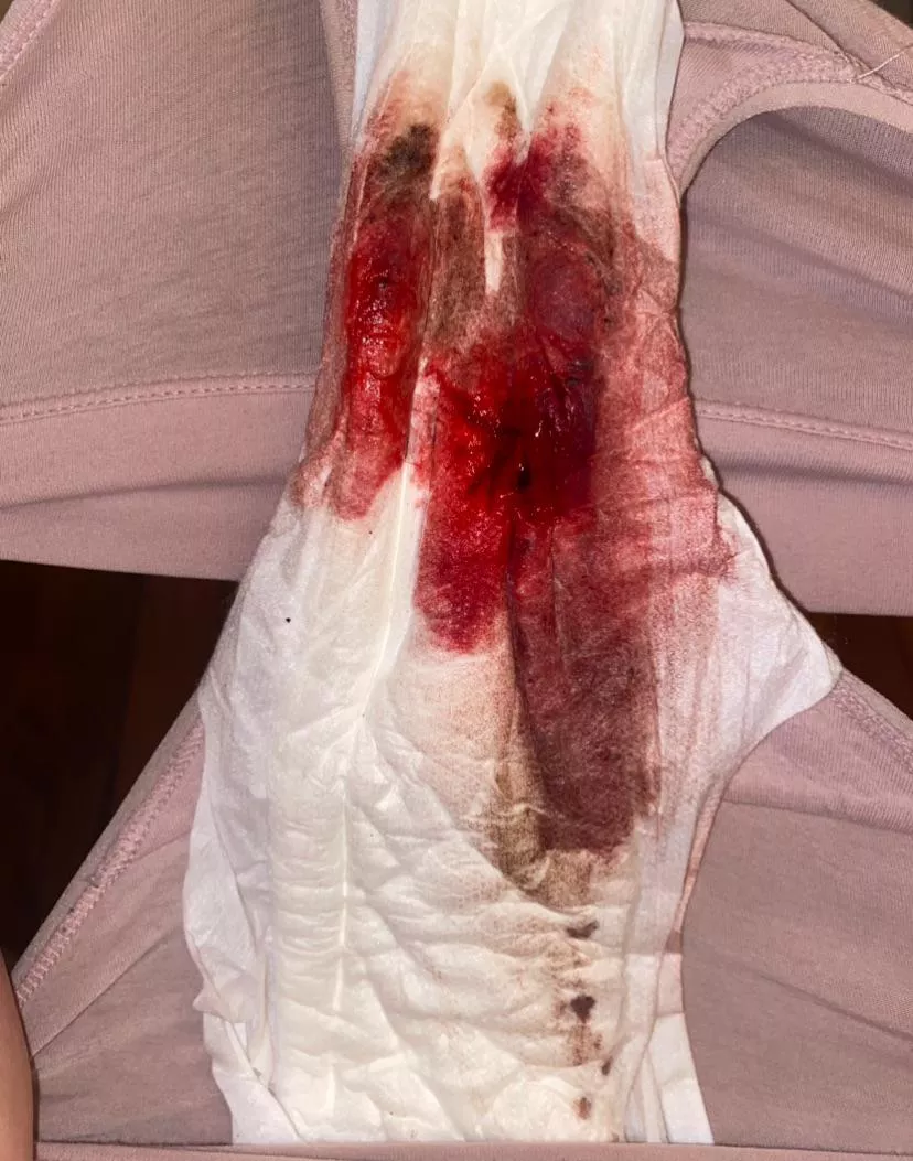 today i had lots of bright red 🩸