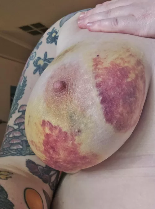 Day 6 - nipple bruising really shiny through today 