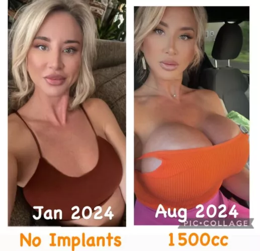 No implants in January, 1500cc by August