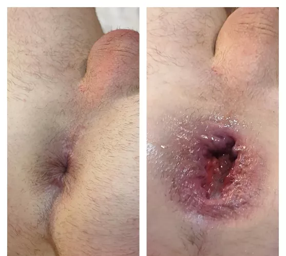 Before and after big plug