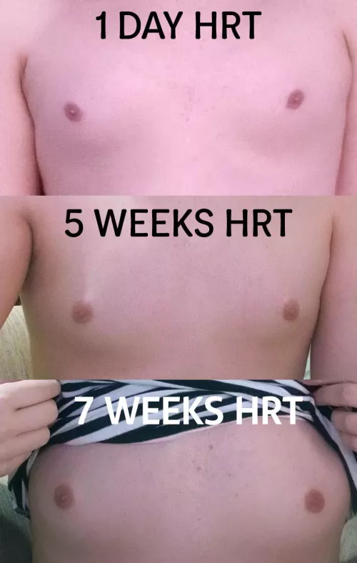 7 weeks breasts update 2 pumps estrogel on my both inner thighs 