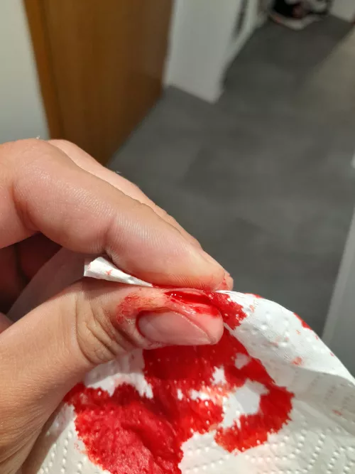 Do I need stitches for this?