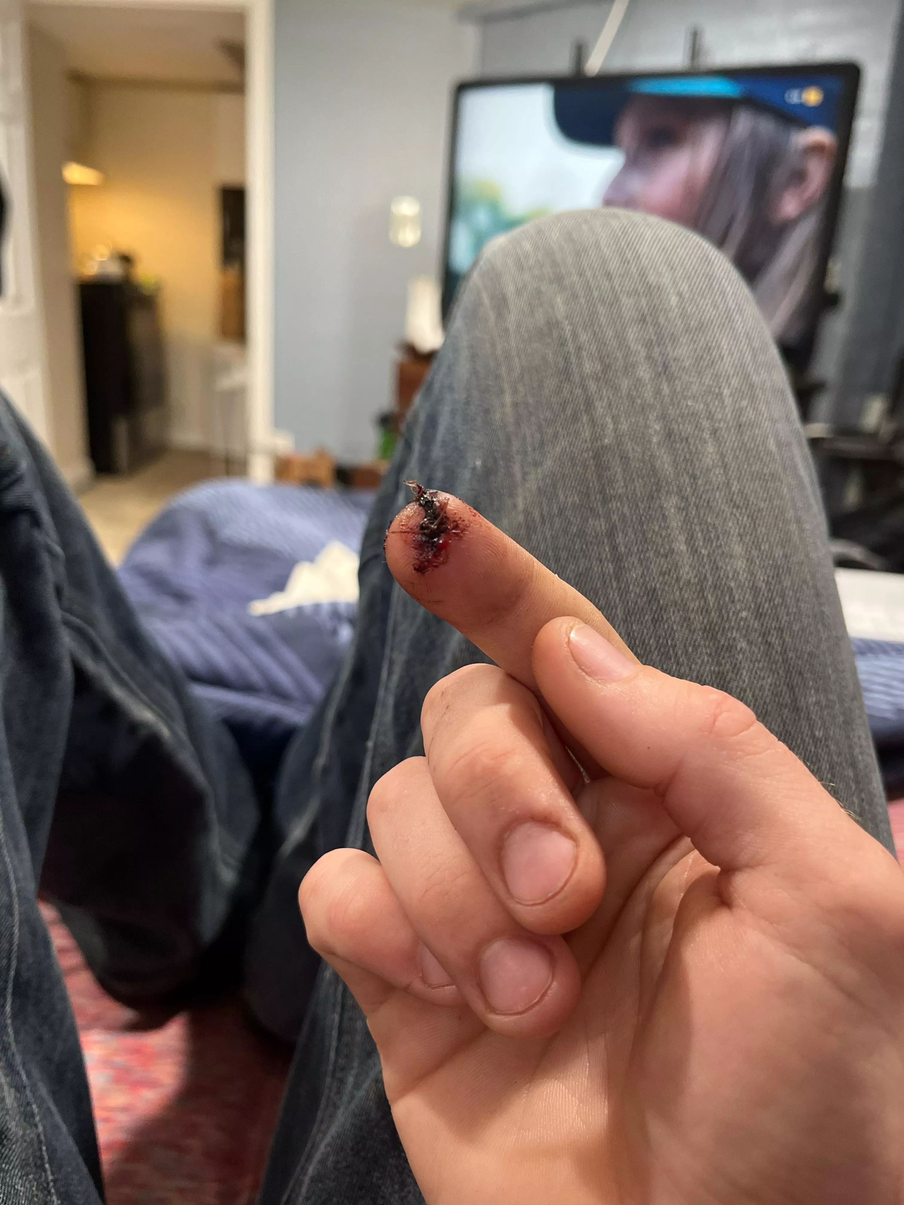 Follow up to chop saw accident 