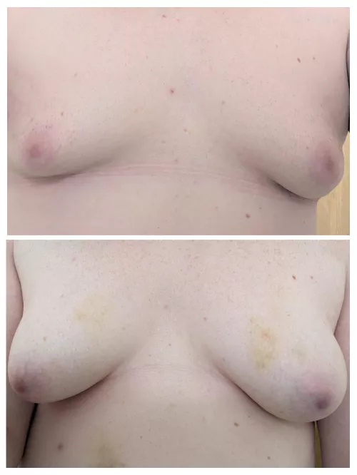 Pre-hrt Gynaecomastia 0 months to 10 months.