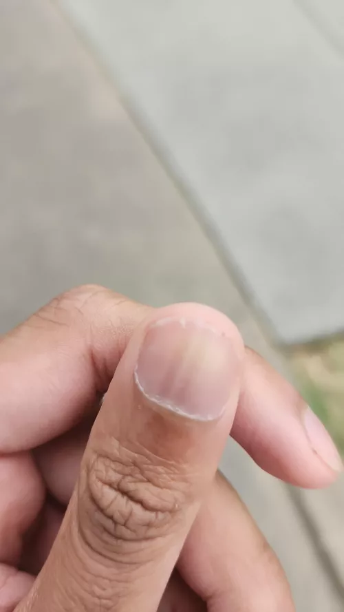 What is this on my nail? Please help 