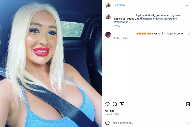Clinic injector brags about injecting her own lips
