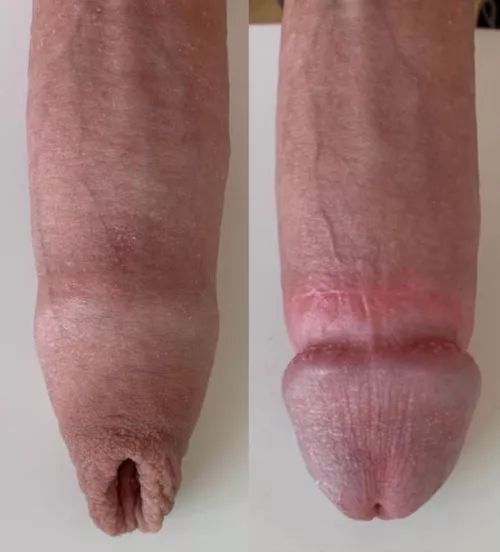 Before and 6 months after adult circumcision 