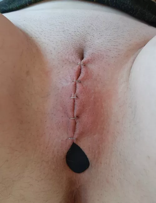 Plugged and Painfully Stapled Shut