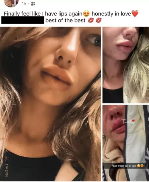 Getting 1ml after a breakup