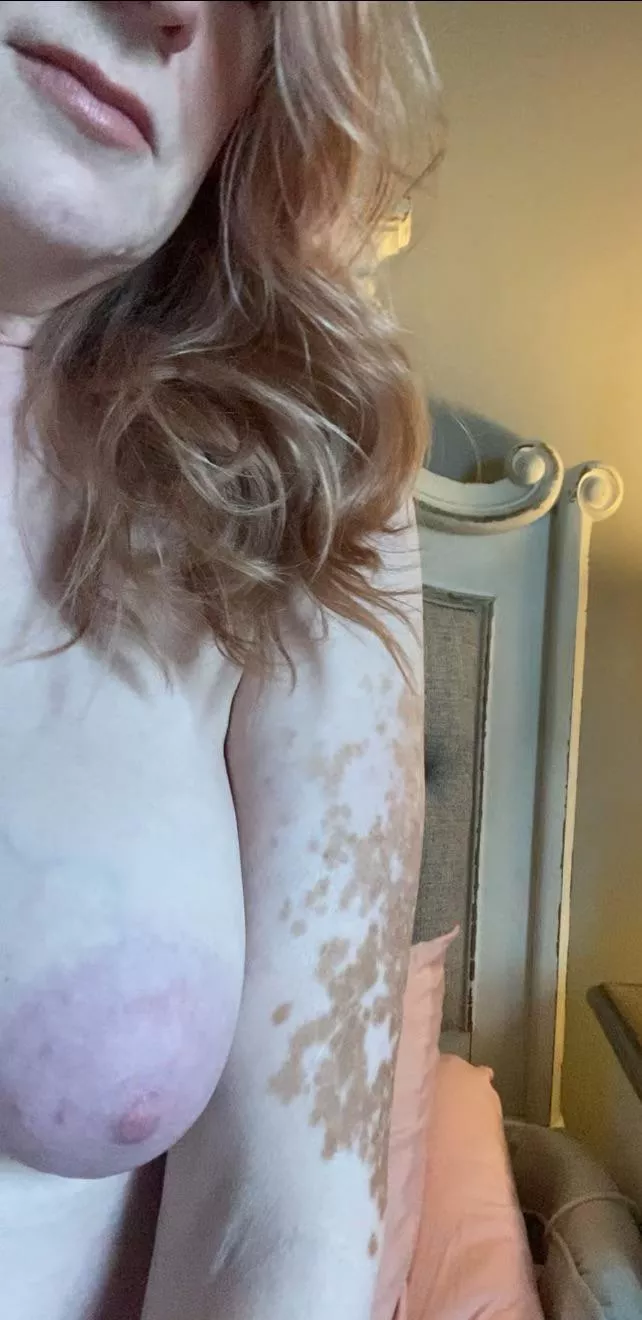 35 years plus with vitiligo. 