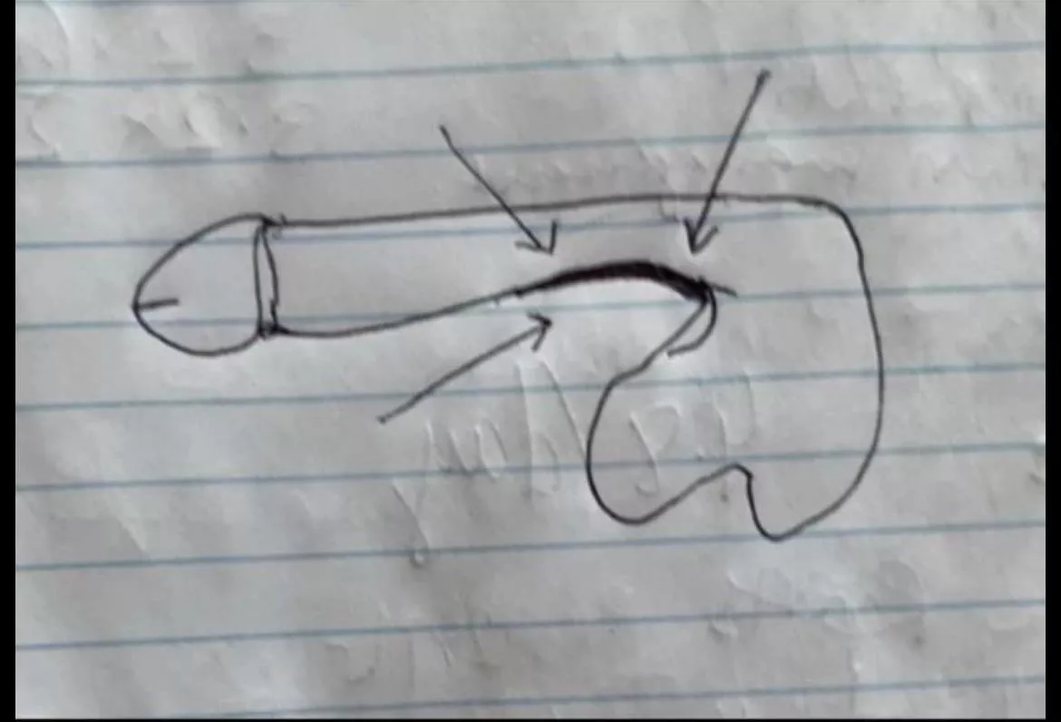 Dent at the base of the CS. I also feel as this contributes to my downward curve. 