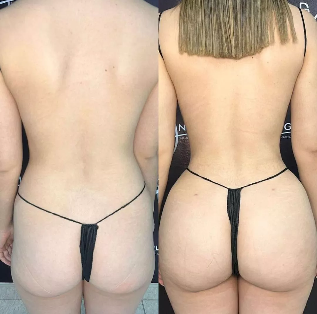 Before/after of liposuction 360 + BBL 