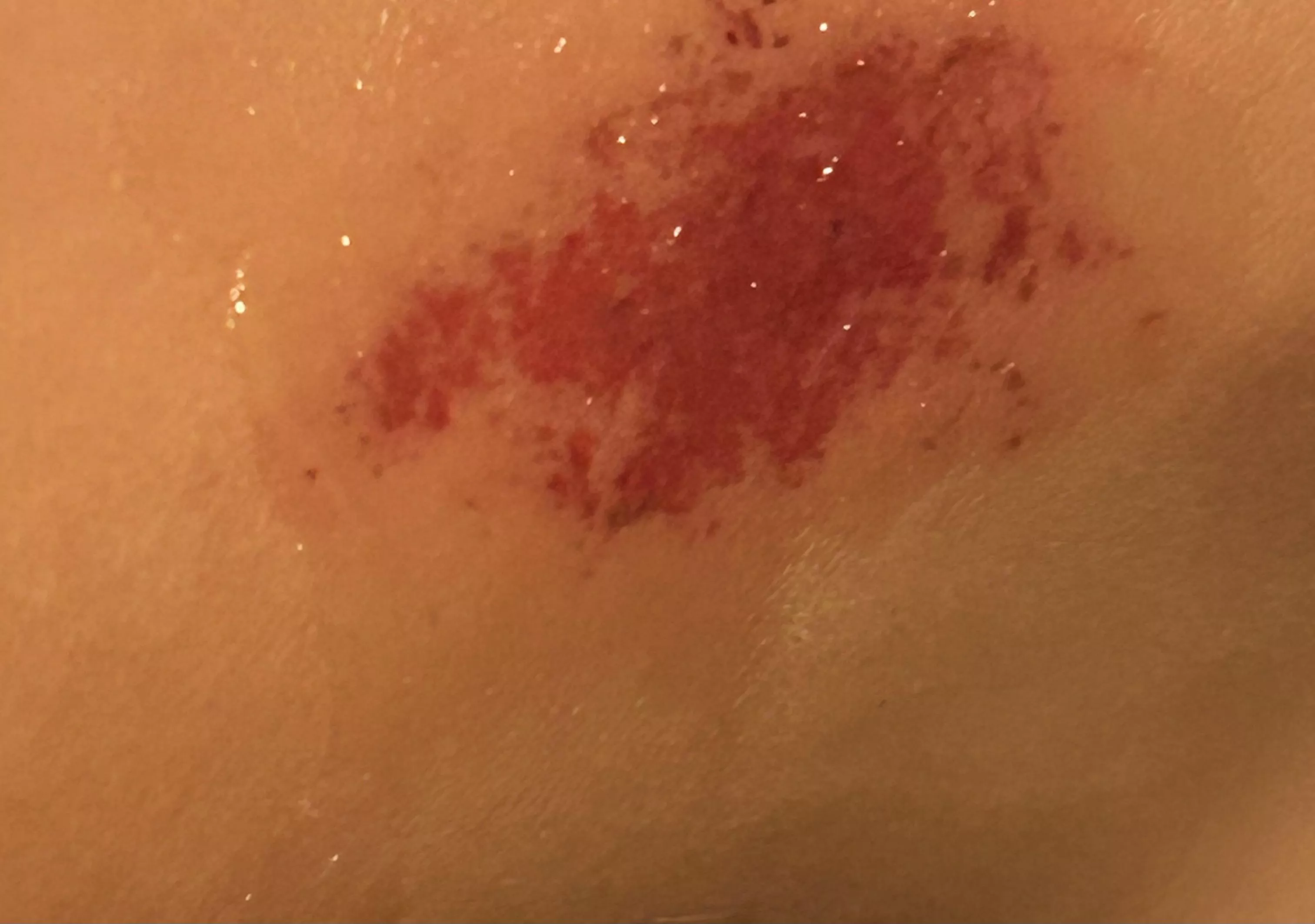 Got burnt and tripped during a camp fire