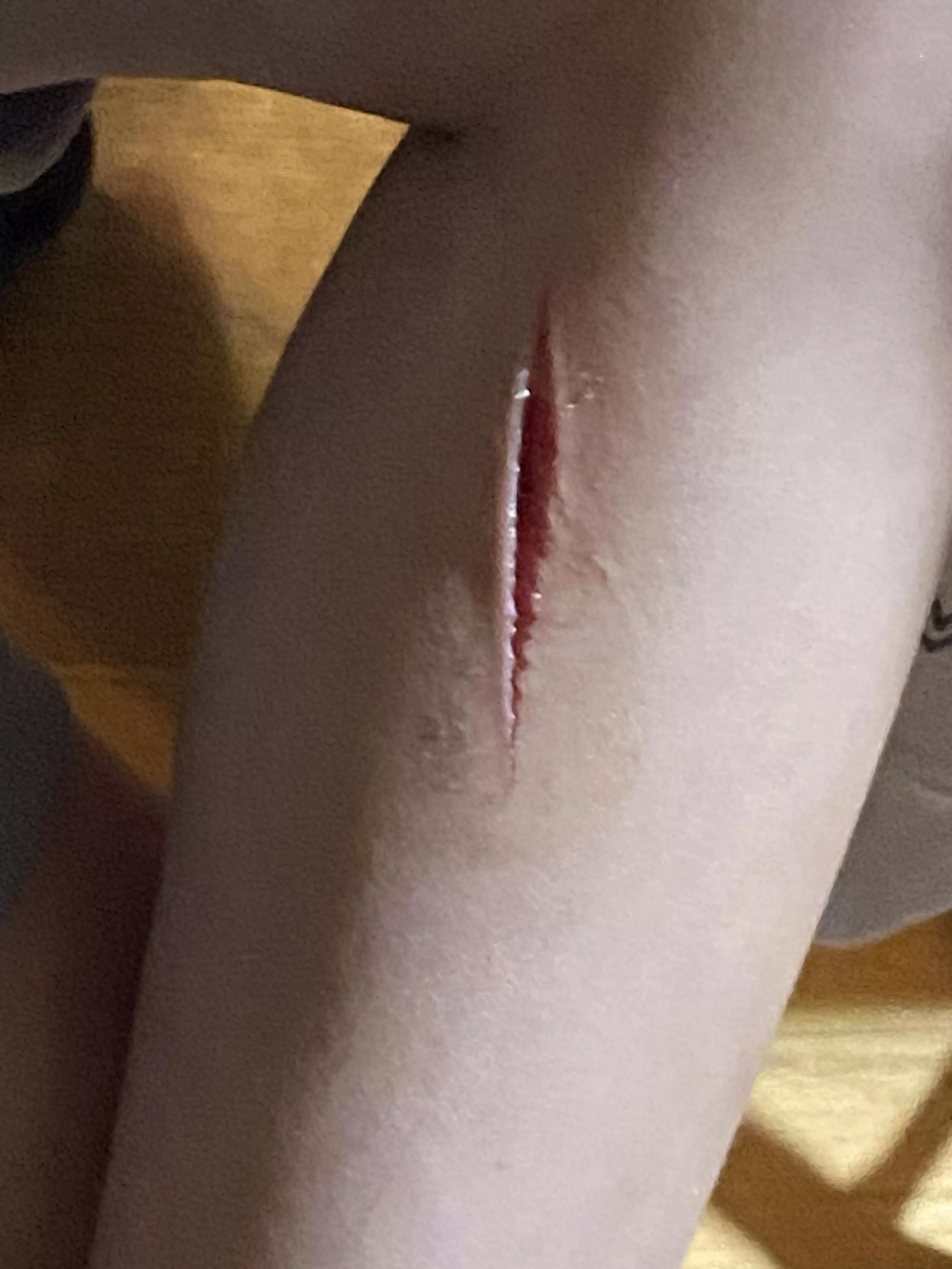My little brother (7) cut his leg open while playing outside 
