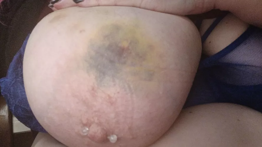 1 week old bruises....pretty!🥰