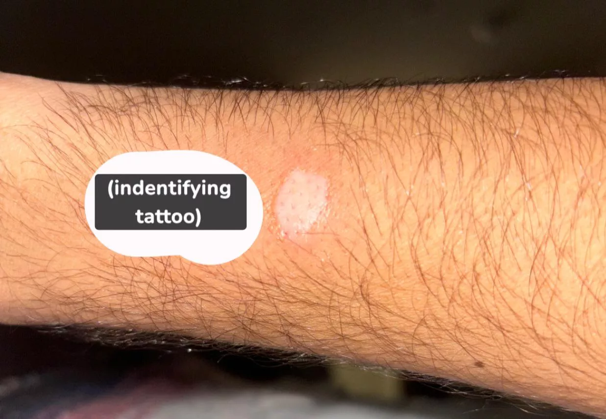 coverage burn on wrist occurred about 30 mins ago