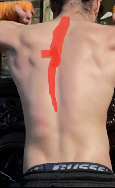 Questions about pain in trap and shoulder blade muscles