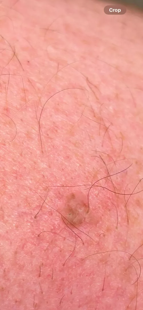 Strange Skin Spot.  See a Dermatologist or not?