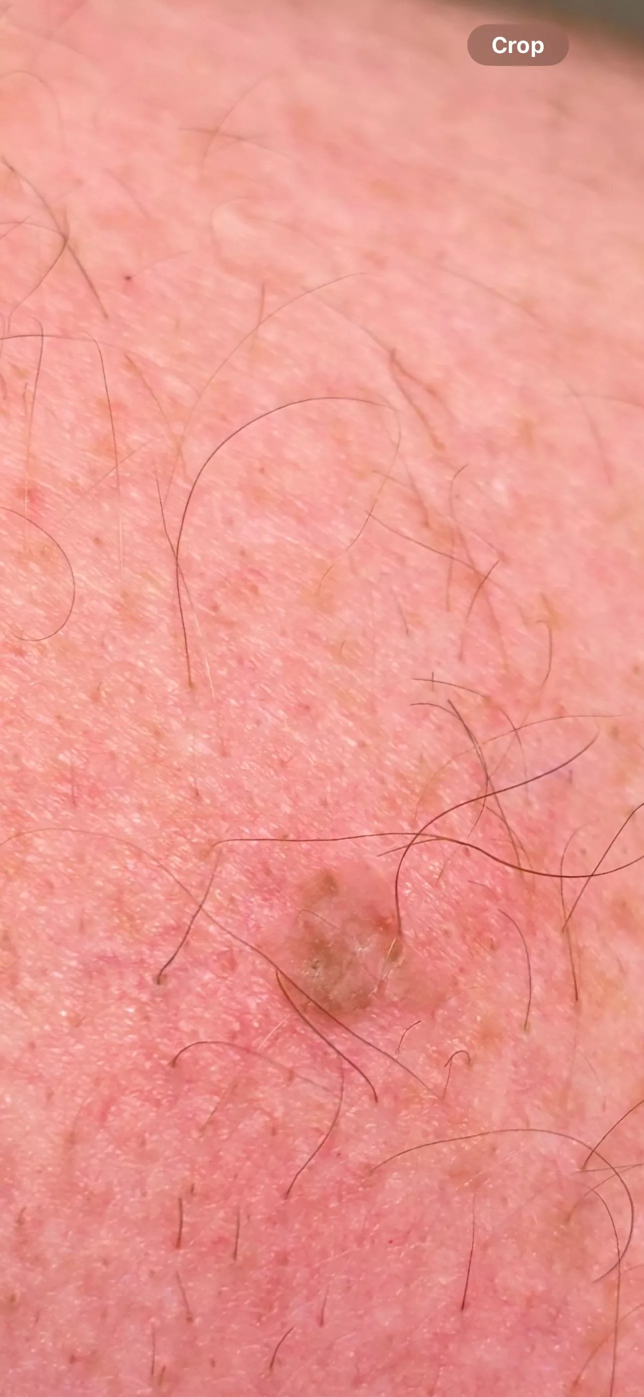 Strange Skin Spot.  See a Dermatologist or not?