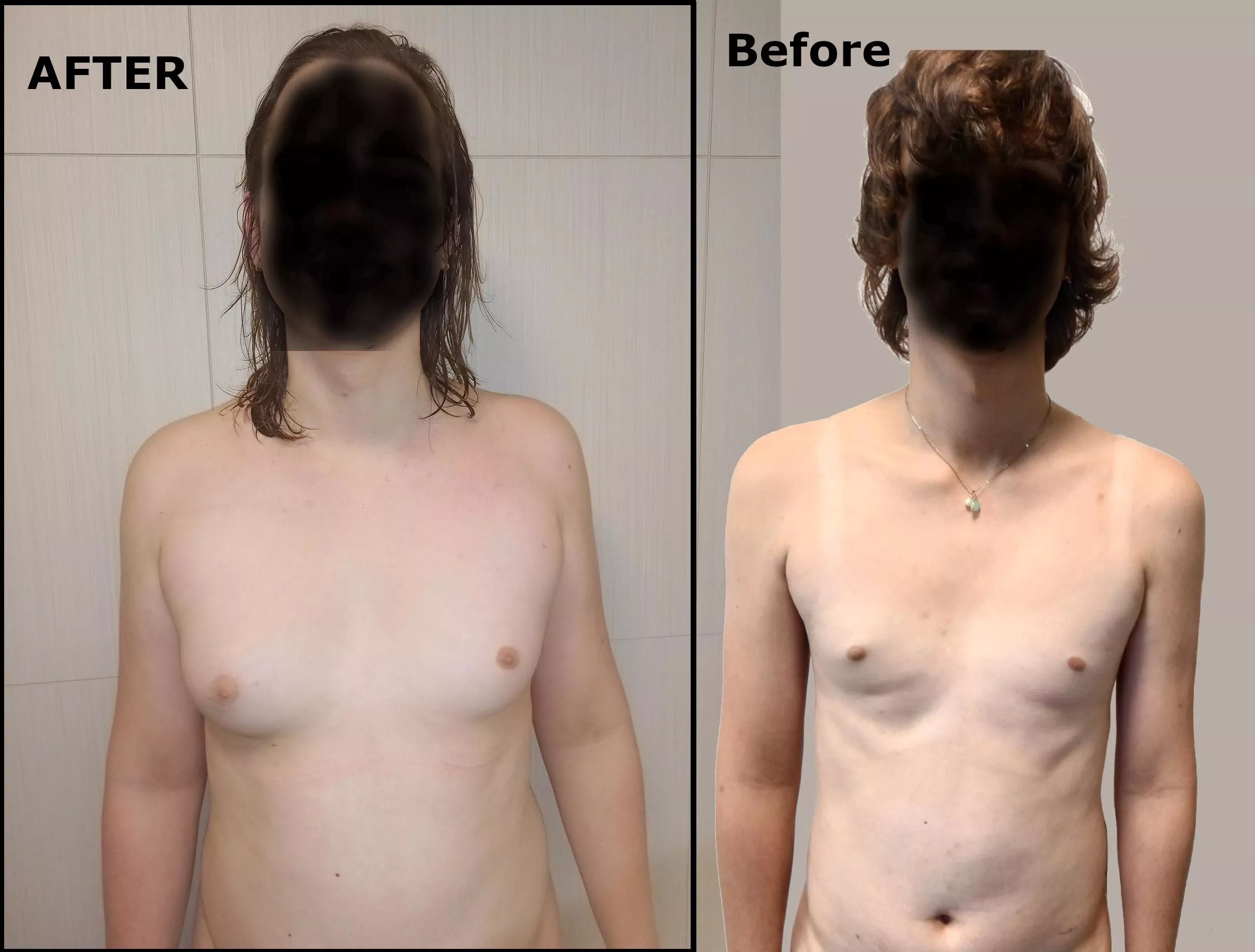 2-3 years of HRT 50mg spiro & 100mg patches