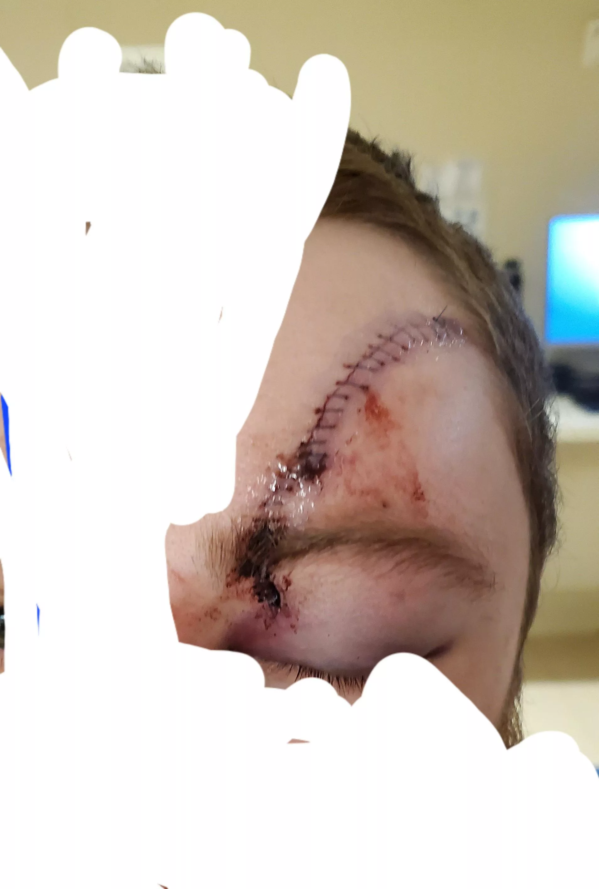 I had a seizure and fell face first. One of the titanium plates holding my skull together split my forehead open!