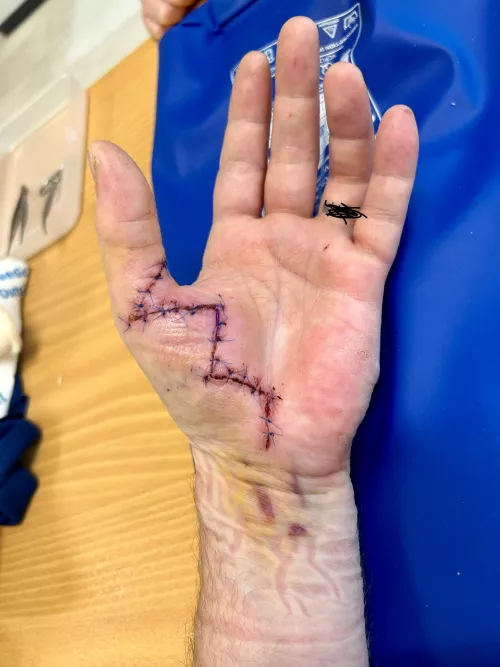 Now rocking a built-in ‘Zigzag Zone’ – 12 weeks of healing and half-speed project management!