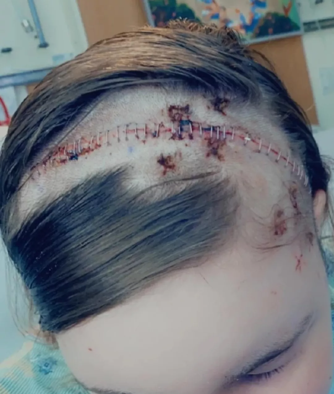 Older pic, but this was my first brain surgery (out of 4)