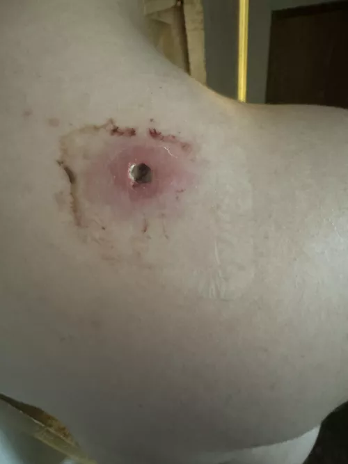 Really bad wound I had from MRSA, April 2024