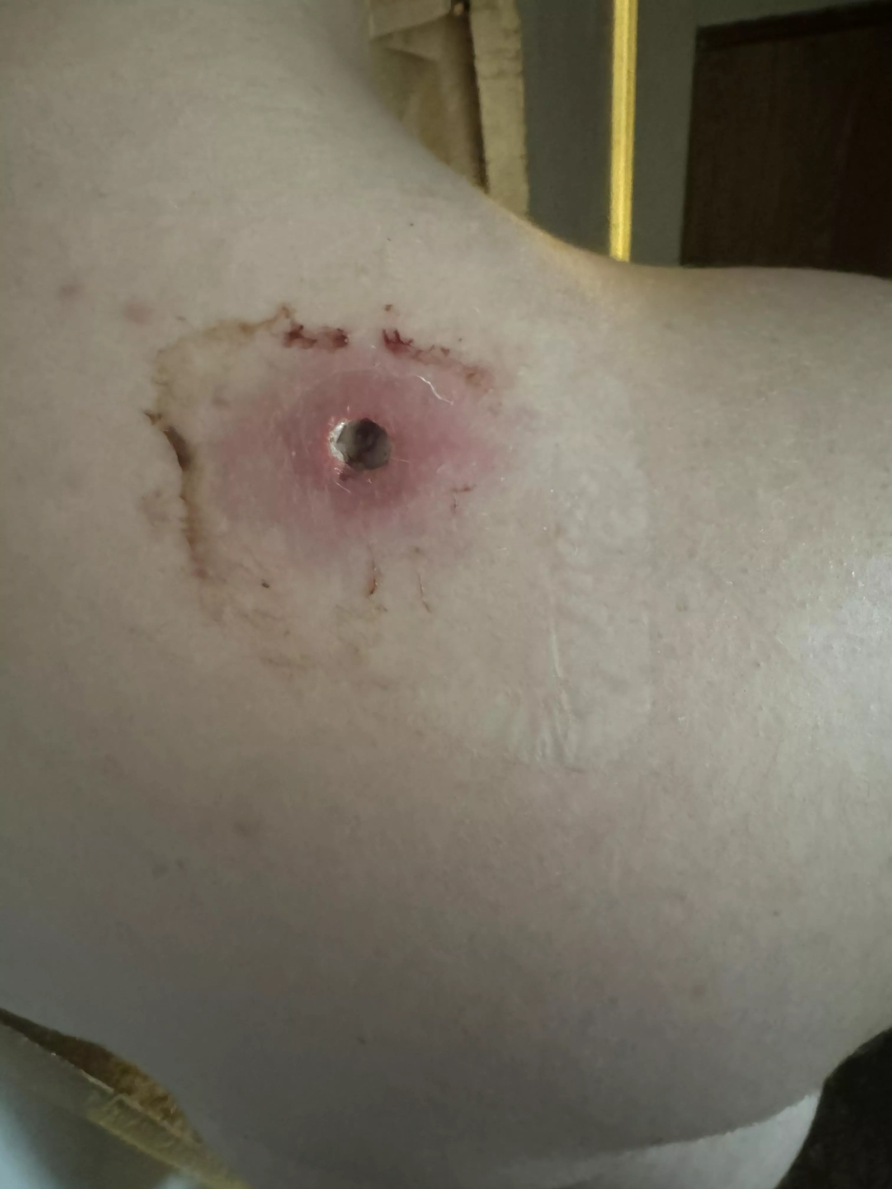 Really bad wound I had from MRSA, April 2024