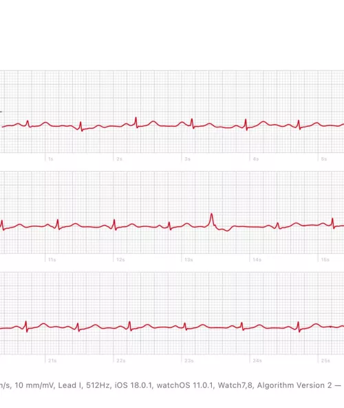 PVCs really scaring me 