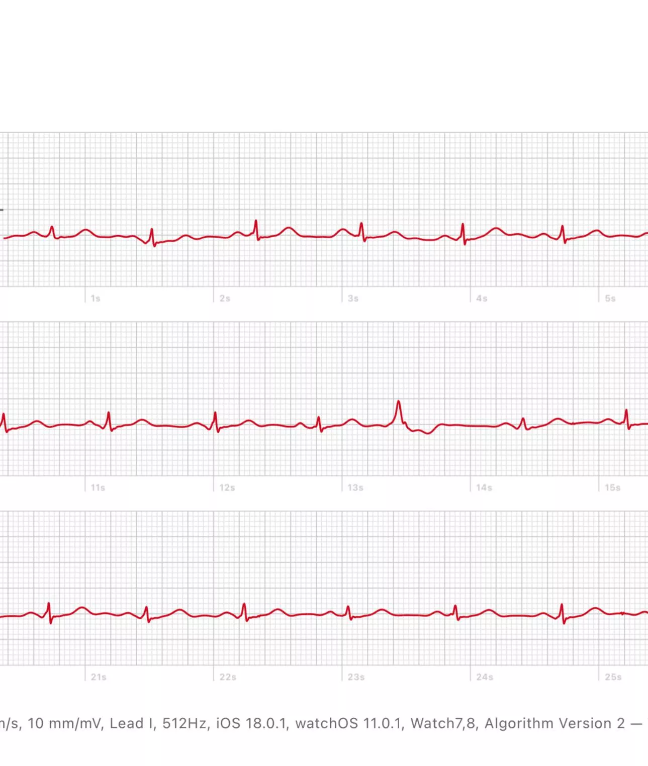 PVCs really scaring me 