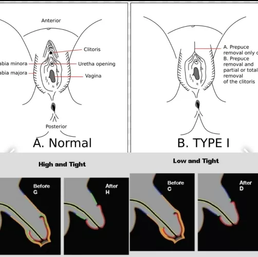 The future is circumcised 