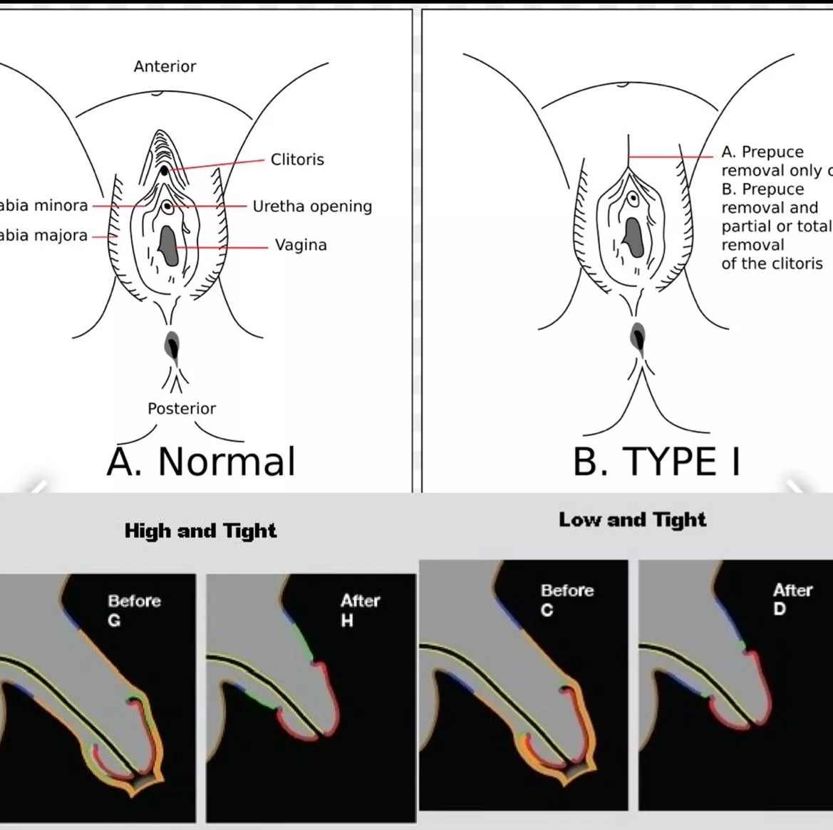 The future is circumcised 