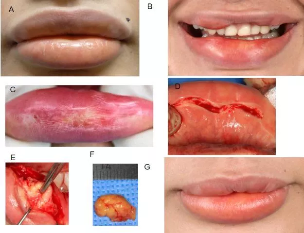 Paraffinoma of the lips and oral mucosa