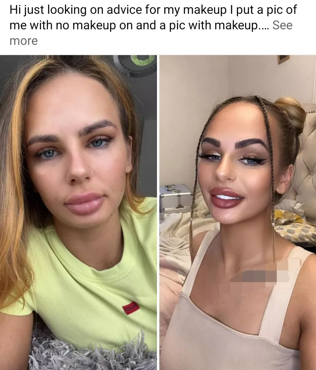 Pretty girl but ooof those duck lips & filler moustache 