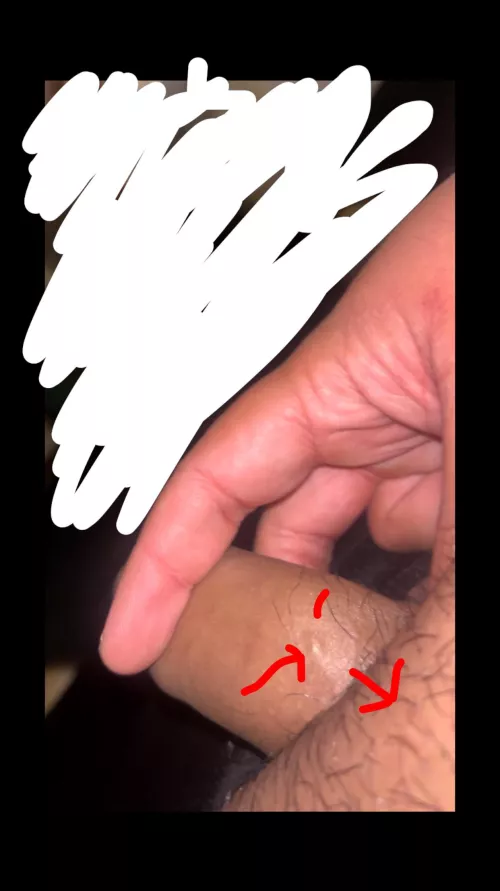 sclerosing lymphangitis