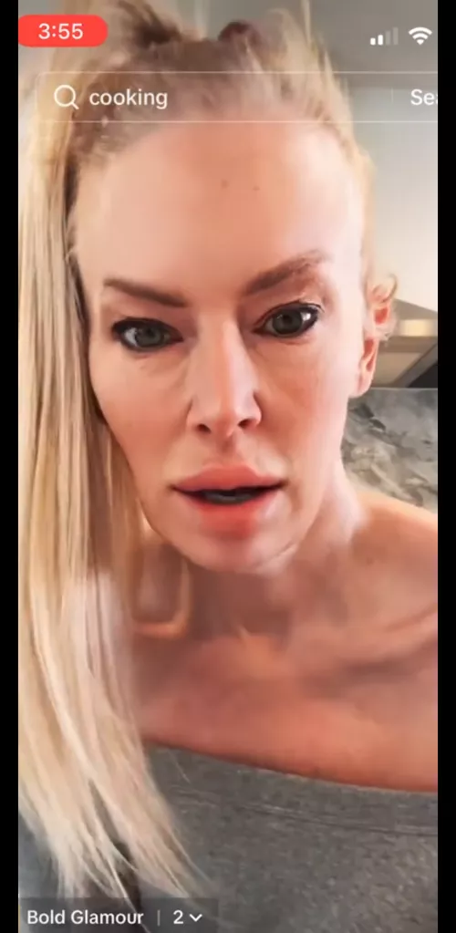 The face lift(s) + the filler. Looks uncomfortable 