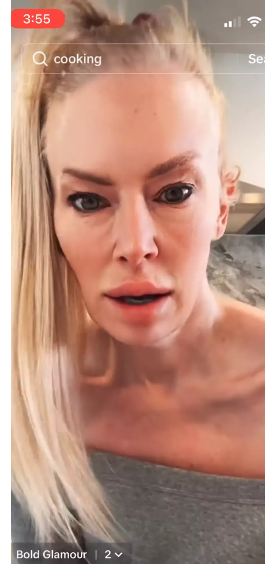 The face lift(s) + the filler. Looks uncomfortable 