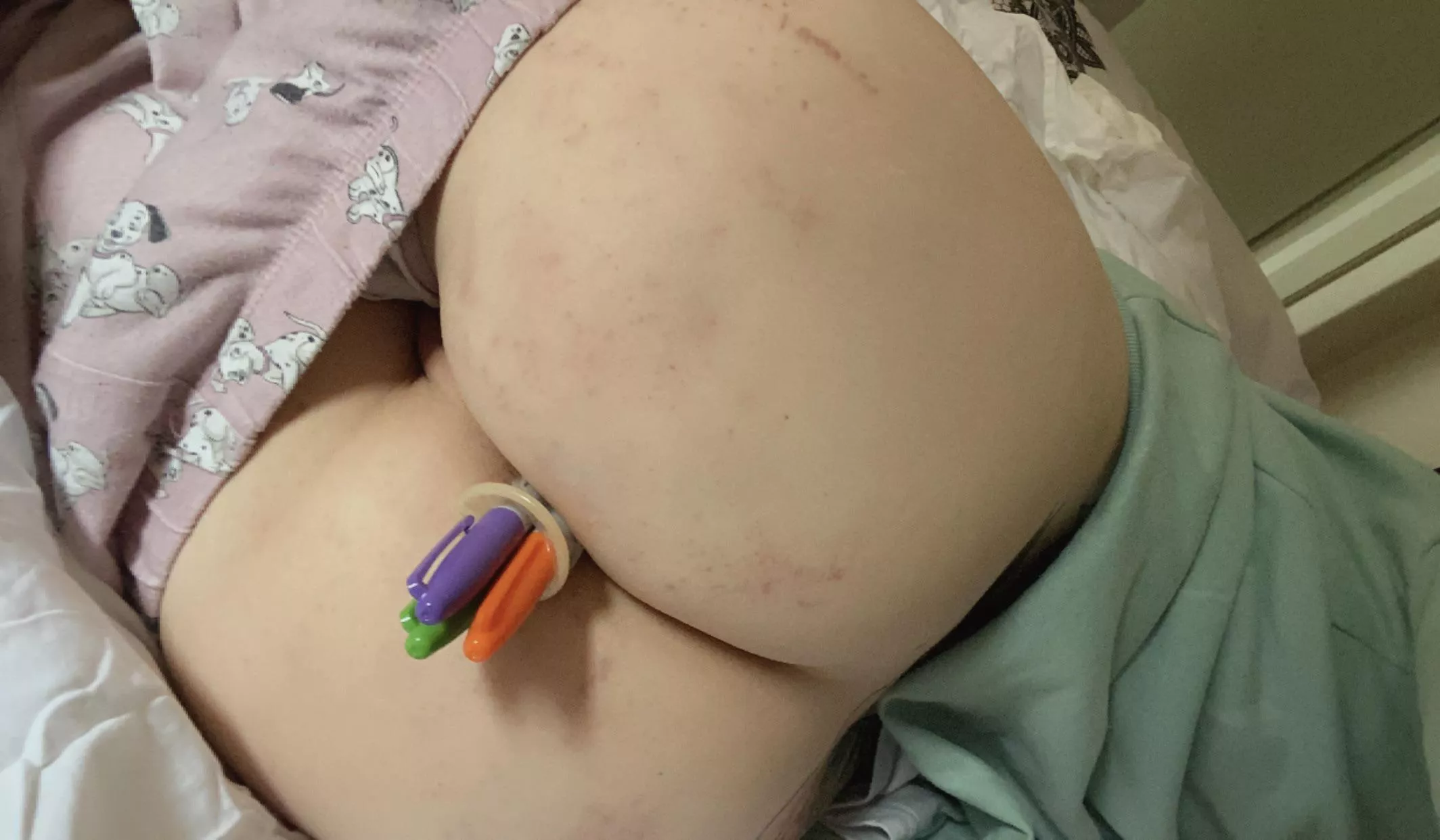 3 this time! In my spanking-bruised butt 🥲