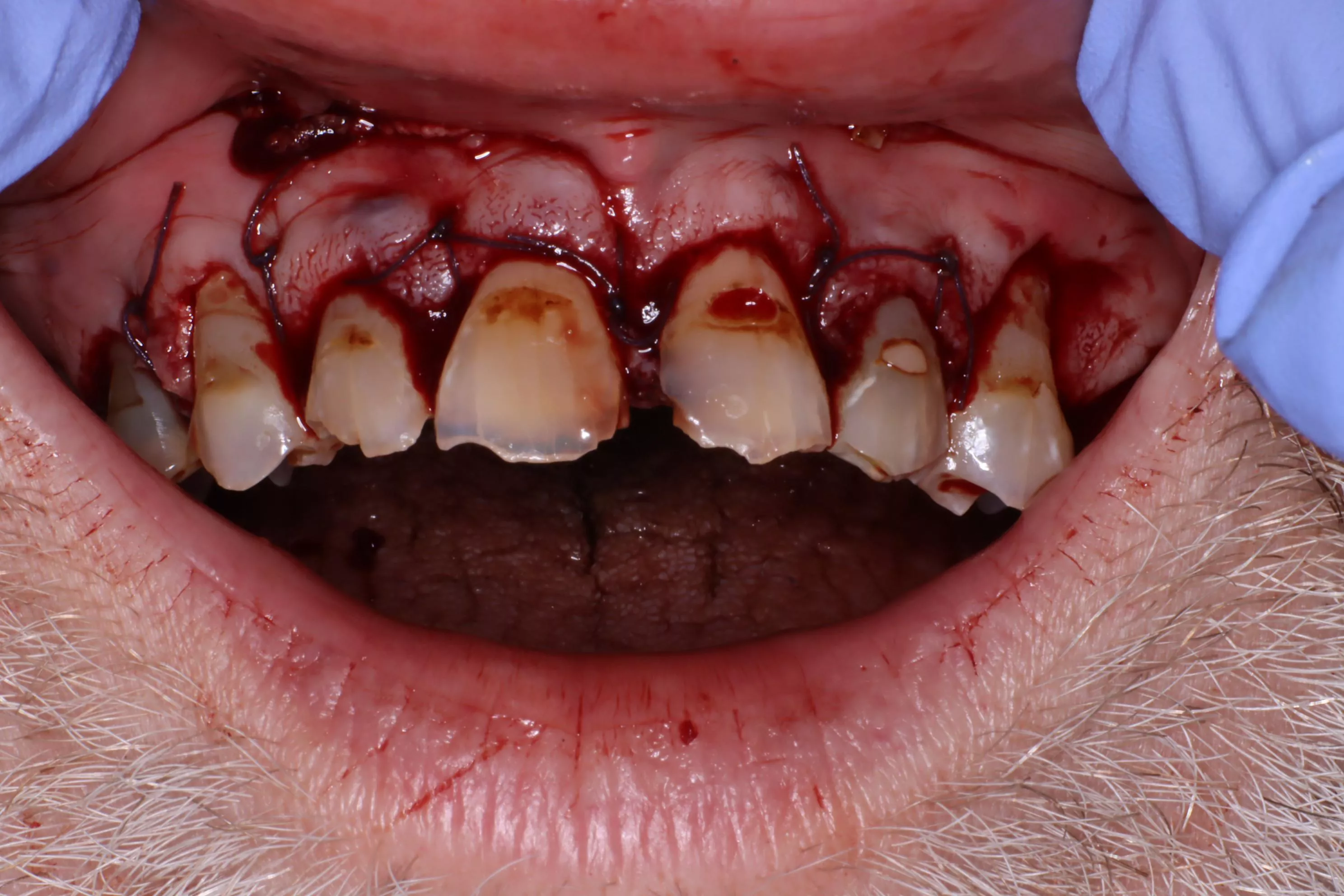 Dental Surgery Yesterday ‘for My Own Good’