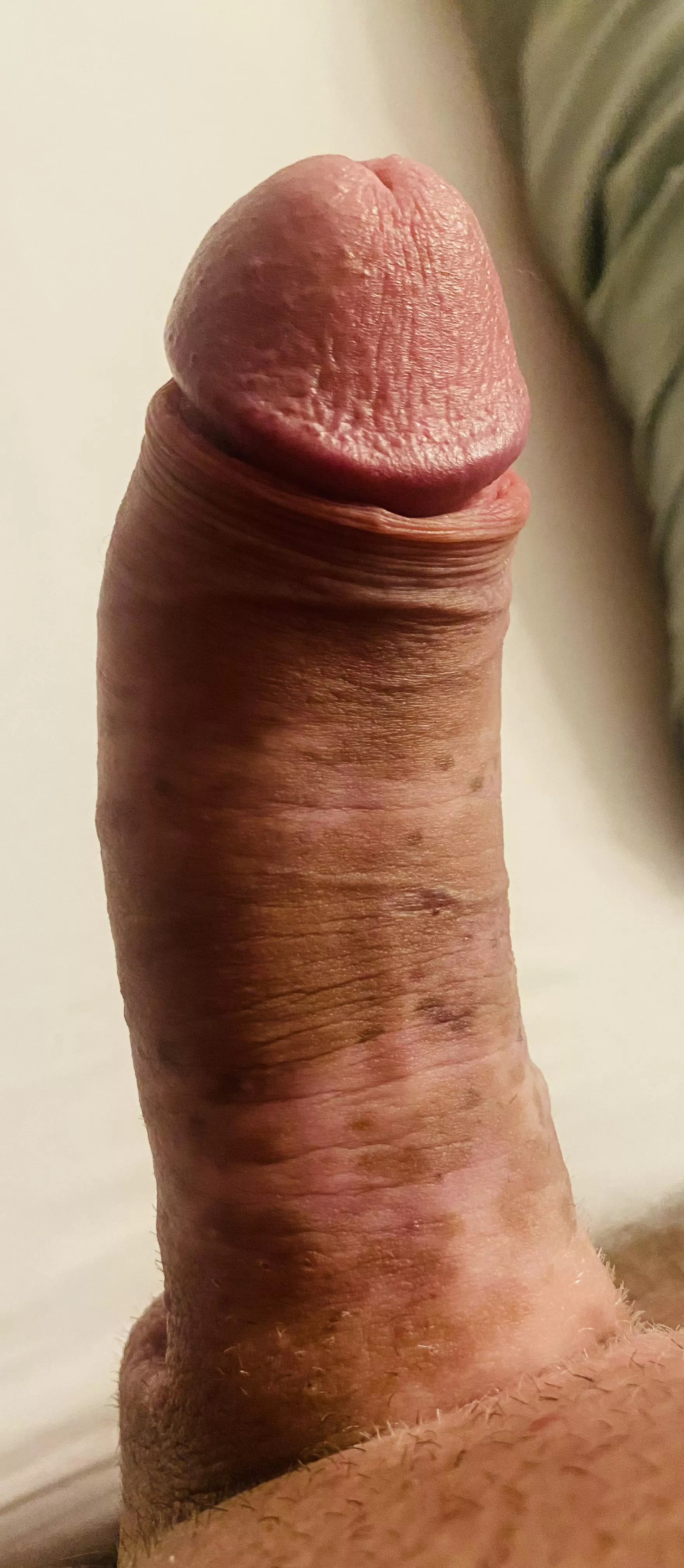 Do you like my vitiligo toy ?