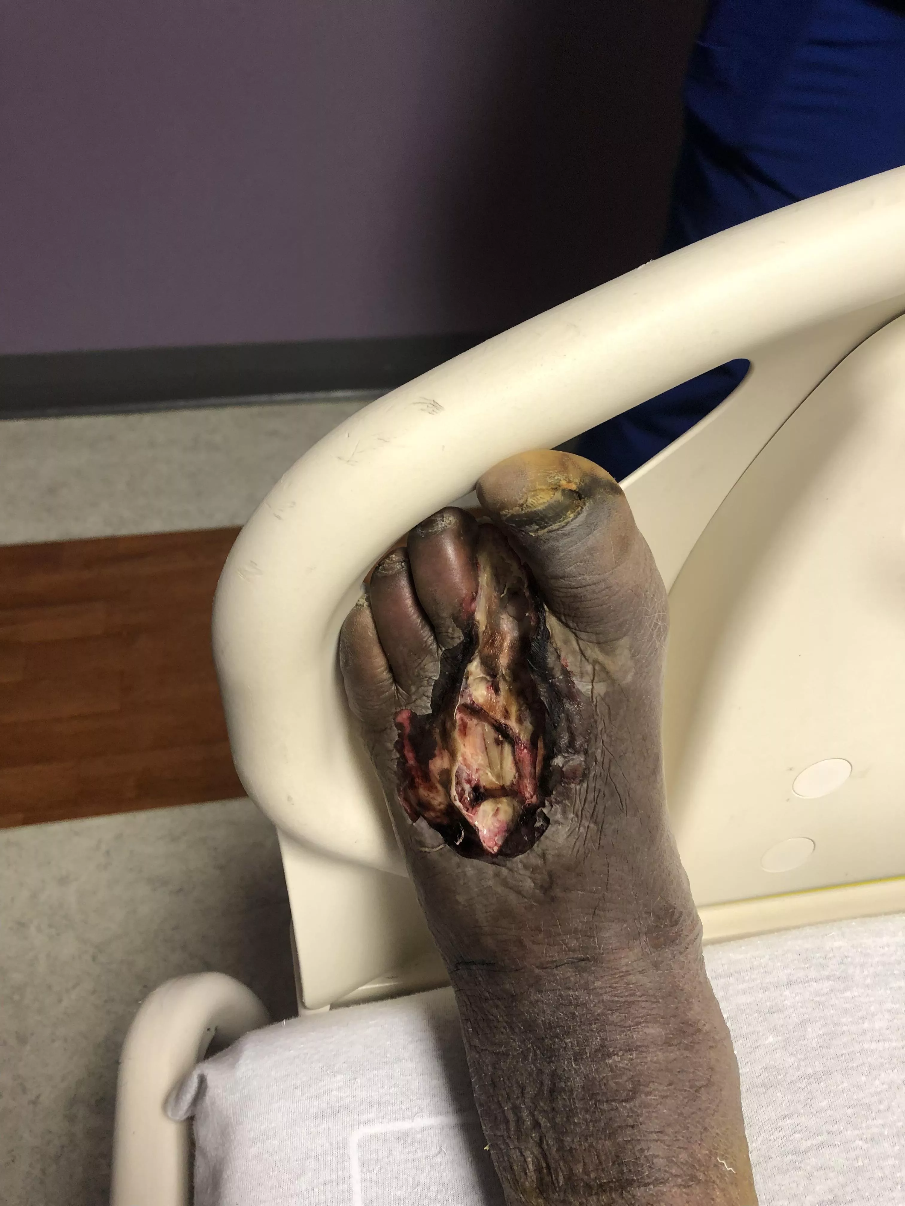 My dad’s bf might have his left foot removed. 