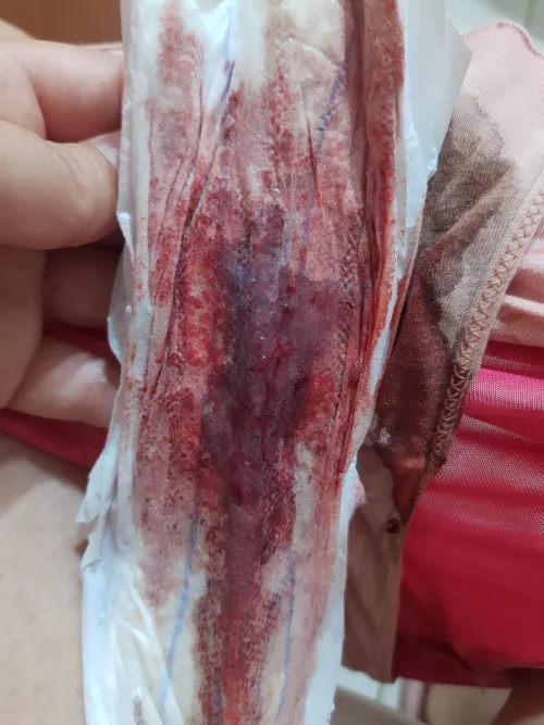 A bit of a hectic first day 🩸