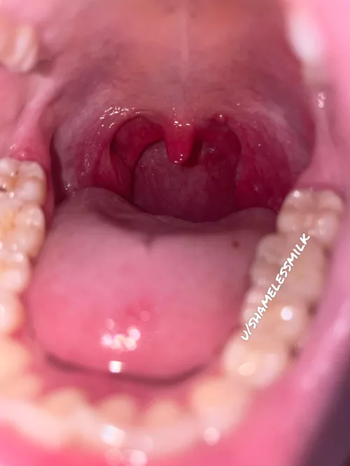 Watch out for my sore throat on your way down!