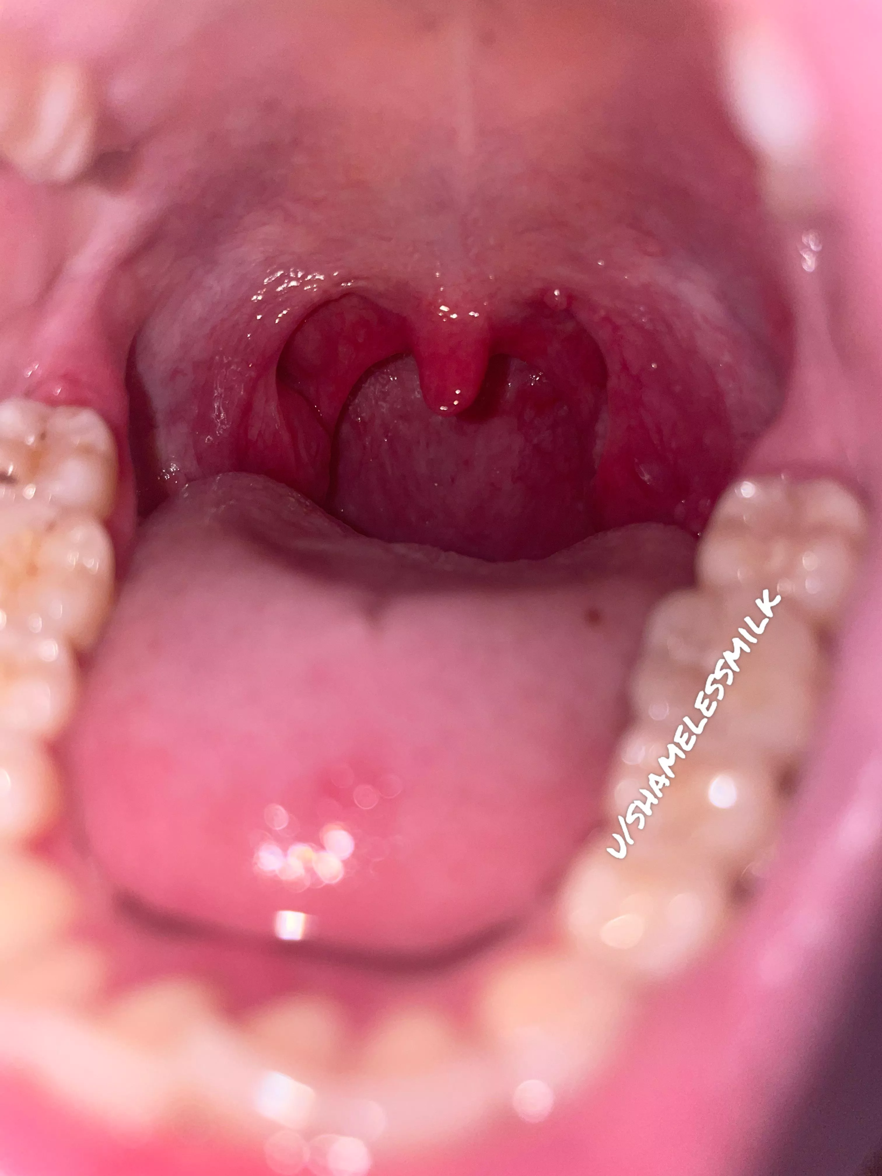 Watch out for my sore throat on your way down!