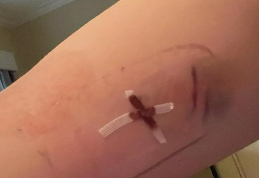 when to take paper stiches off (tw: dried blood and bruising)