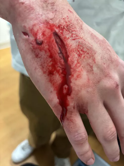 Car crash laceration 