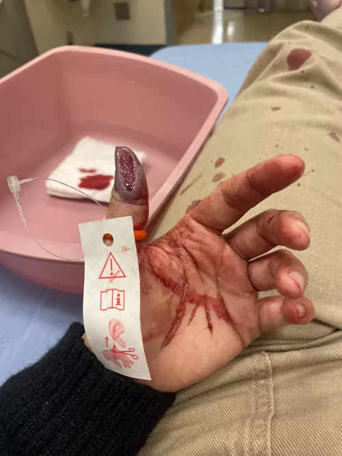 Chunk of thumb sliced off 